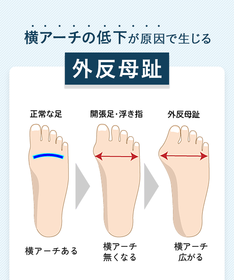 横アーチの低下が原因で生じる外反母趾